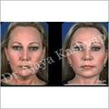 Manufacturers Exporters and Wholesale Suppliers of Forehead Lift Surgery New Delhi Delhi